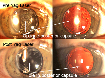 Yag Laser Capsulotomy Maidstone Eye Practice