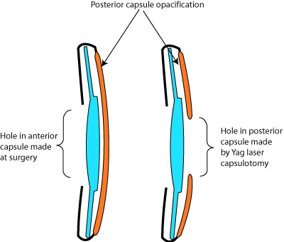 What is deals yag laser