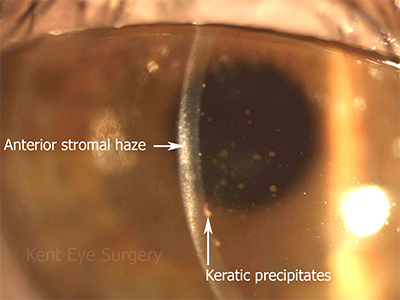 keratic precipitates